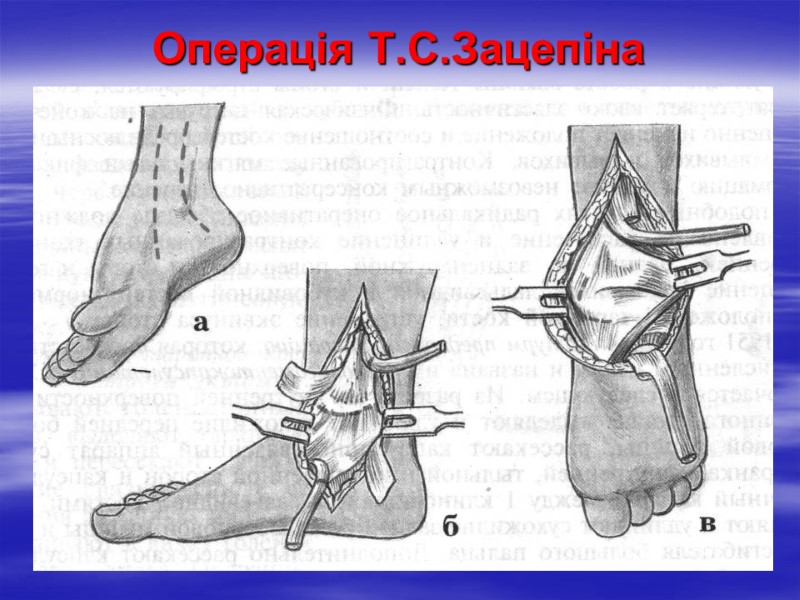 Операція Т.С.Зацепіна